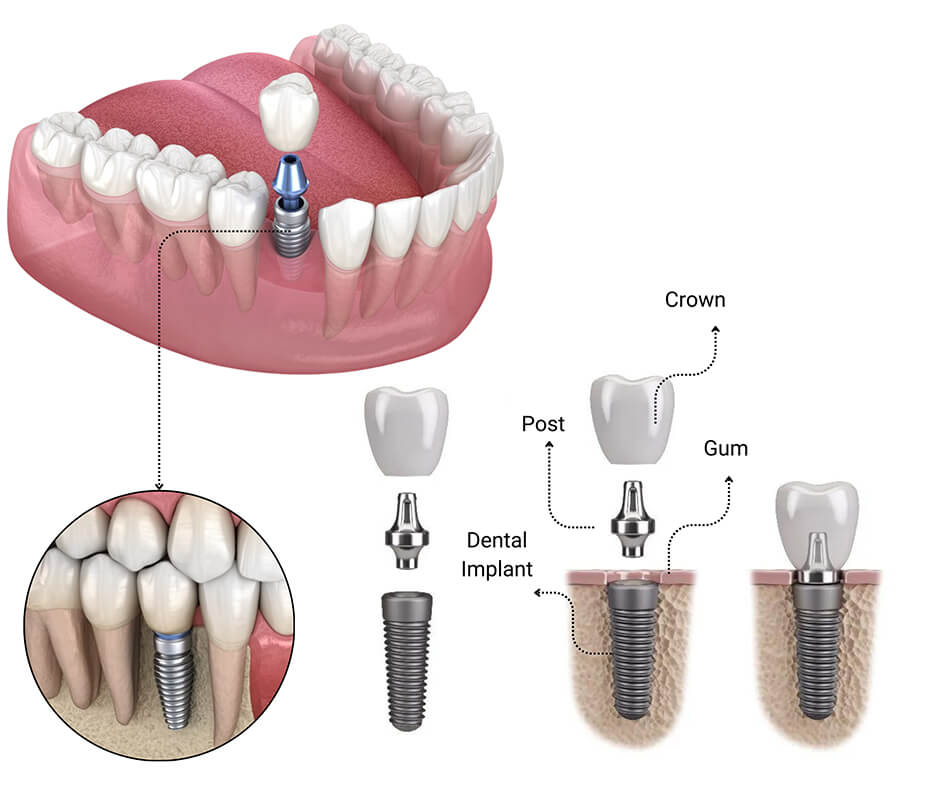 Dental Implant in Lahore